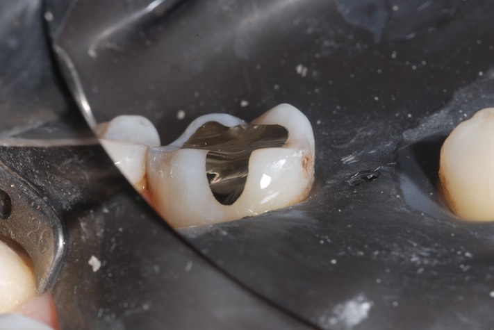 Charlie Sugiyama #19 finish buccal view