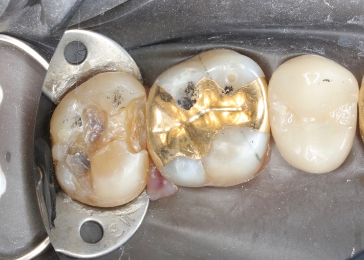 Chris Woo #15 caries removal