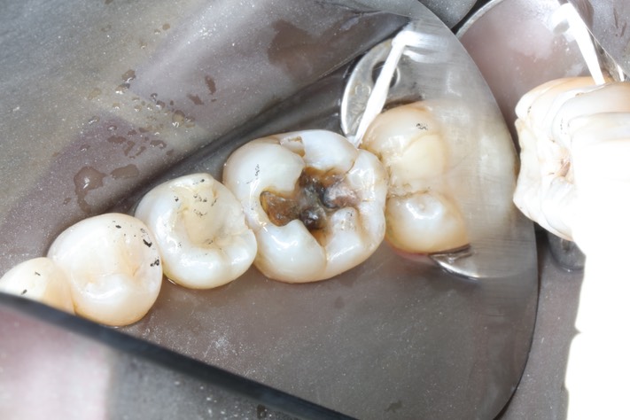 Chris Woo #19 amalgam removal