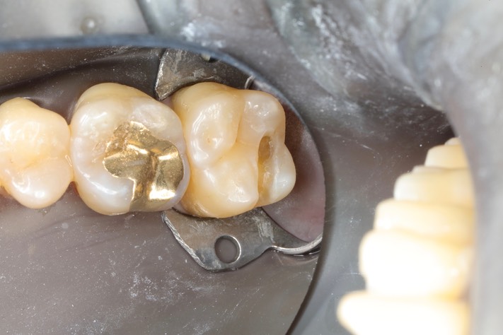 Chris Woo #2 composite removal