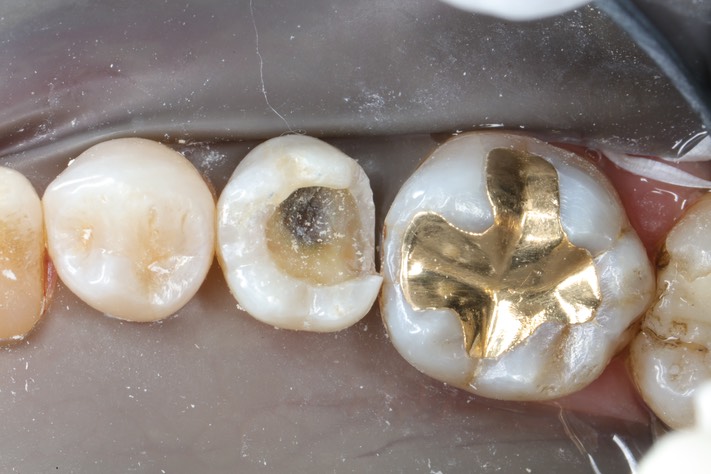 Chris Woo #20 caries removal