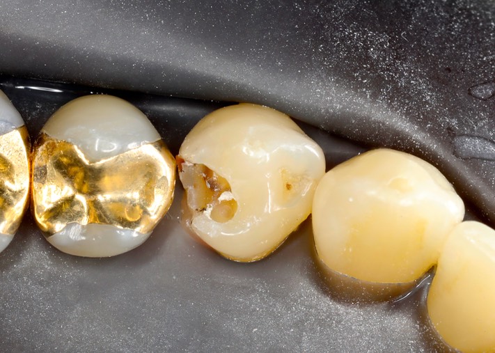 Chris Woo #28 amalgam removal