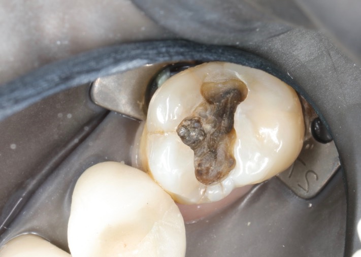 Chris Woo #3 amalgam removal – Version 2