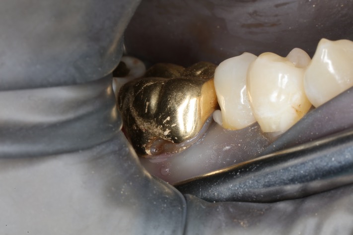 Chris Woo #30 caries removal