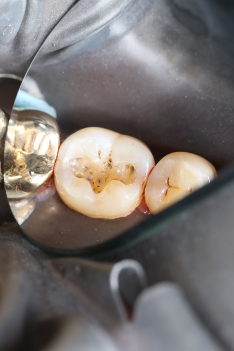 Chris Woo #30 composite removal