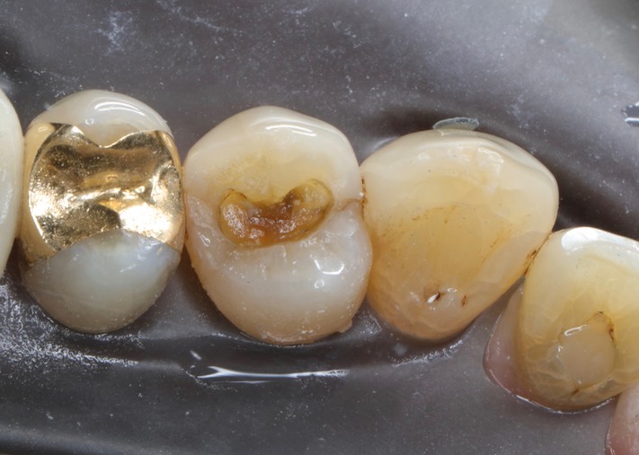 Chris Woo #5 amalgam removal