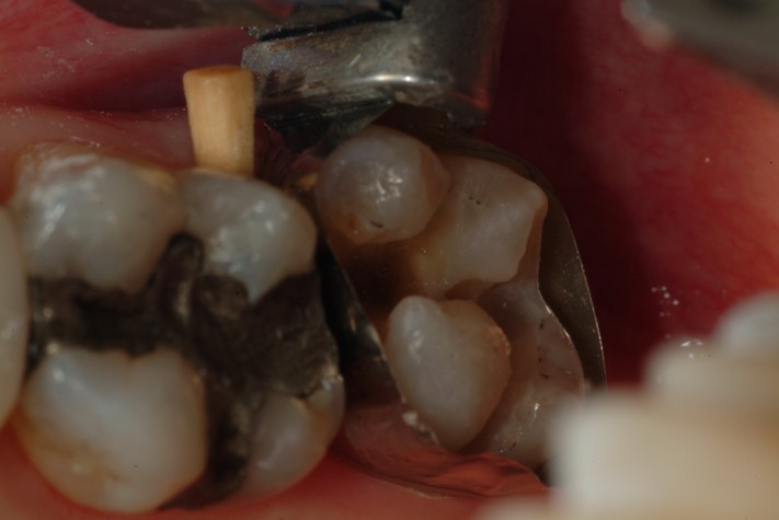 Larry Fujioka #2 pre-buildup