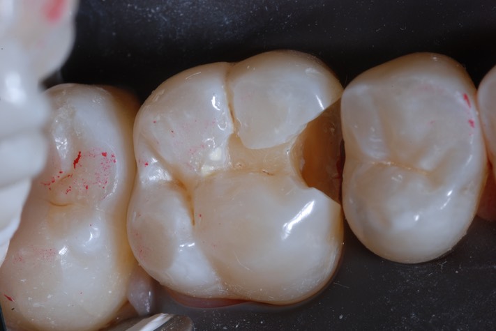 Roland Ylarde #3 comp removal