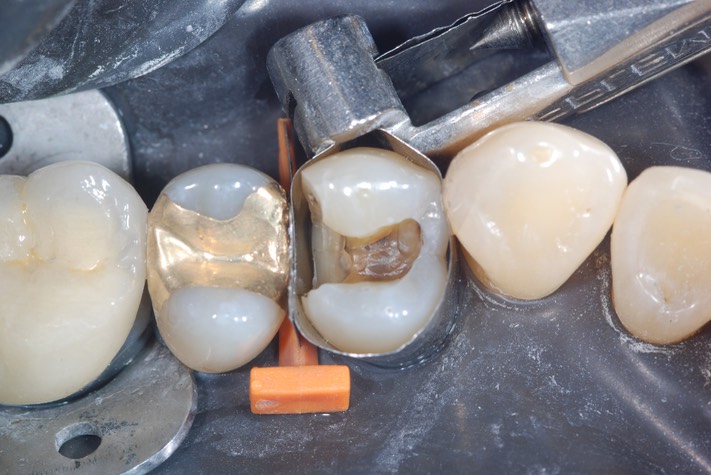 Wayne Chin #12 caries removal