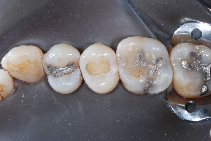 John Wu #4 amalgam removal