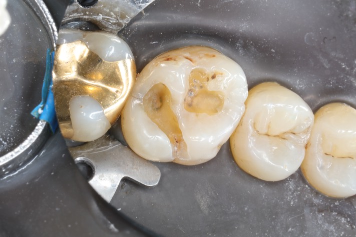 Frank Fukuda #14 amalgam removal