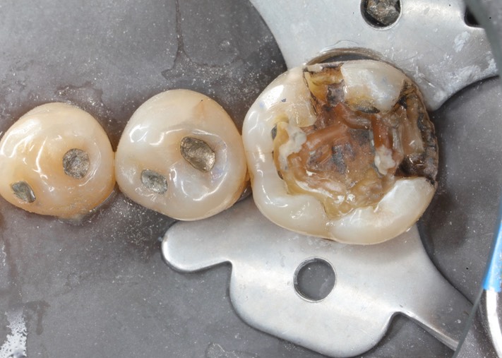 Frank Fukuda #19 amalgam removal