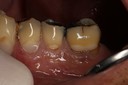 Frank Fukuda #19-20 buccal pre-op