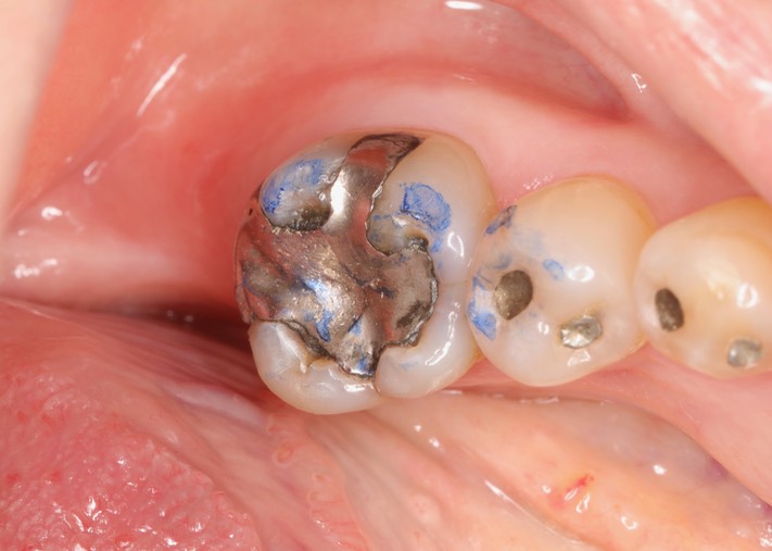 Frank Fukuda #19 pre-op - adjust DL cusp