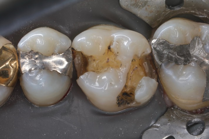 Frank Fukuda #3 amalgam removal