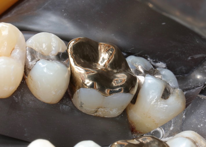 Frank Fukuda #3 lingual view