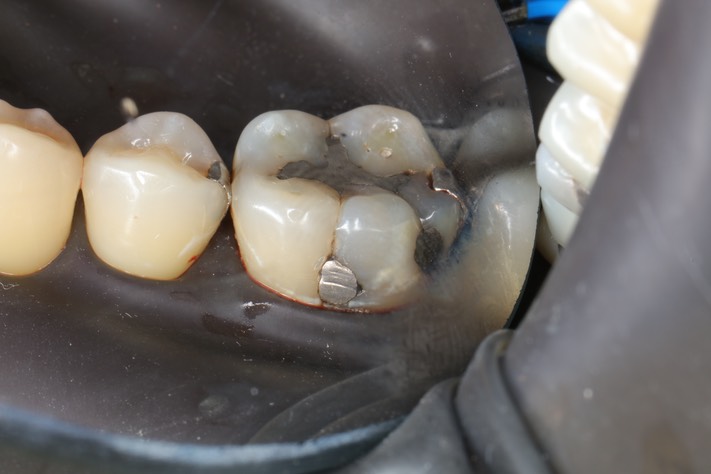 Frank Fukuda #30 pre-op buccal