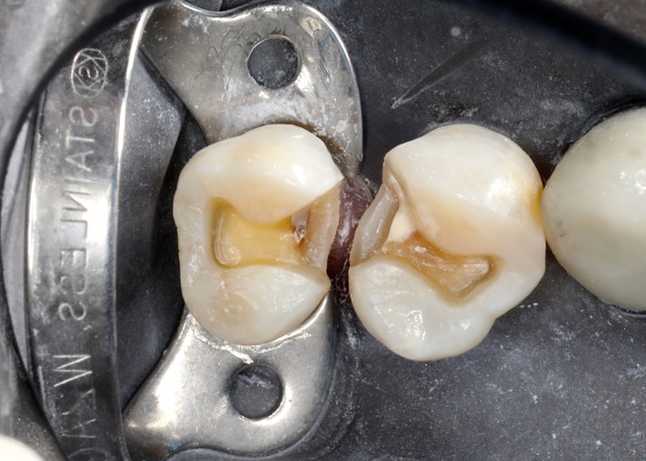 Gary Umeda #12-13 prep