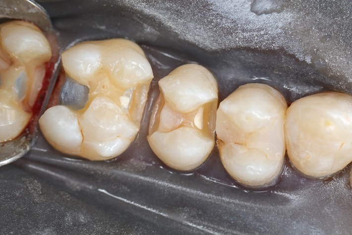 Gary Umeda #13-14 prep