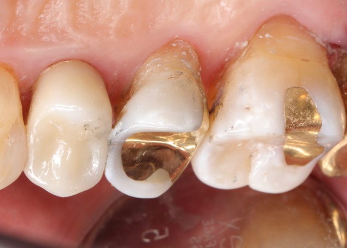 Gary Umeda #13 lingual view