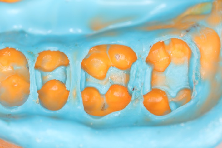 Gary Umeda #13,14,15 impression