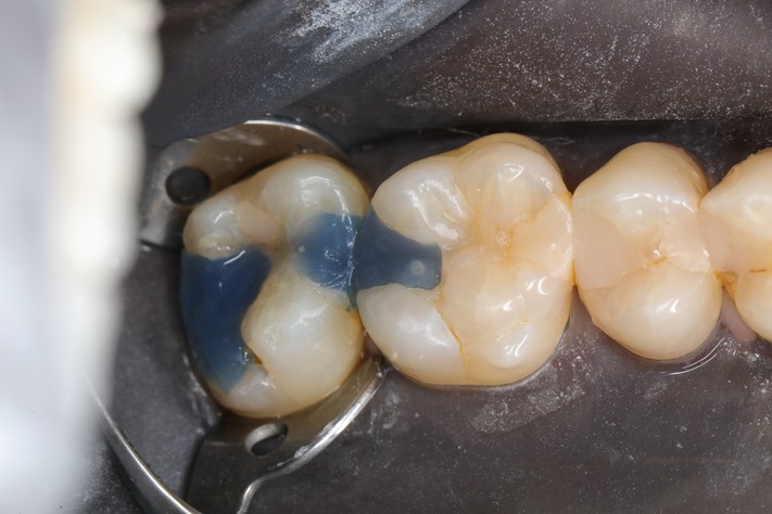 Gary Umeda #14-15 pre-op