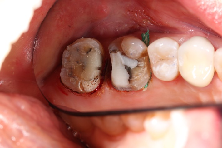 Gary Umeda #14-15 prep 2