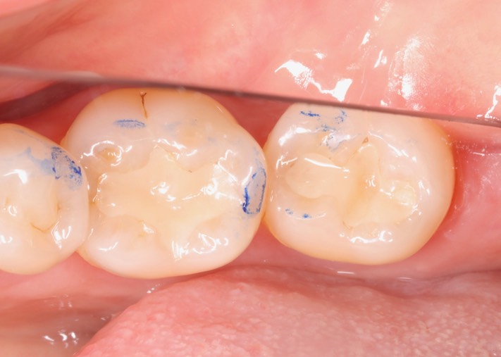 Gary Umeda #18-19 pre-op