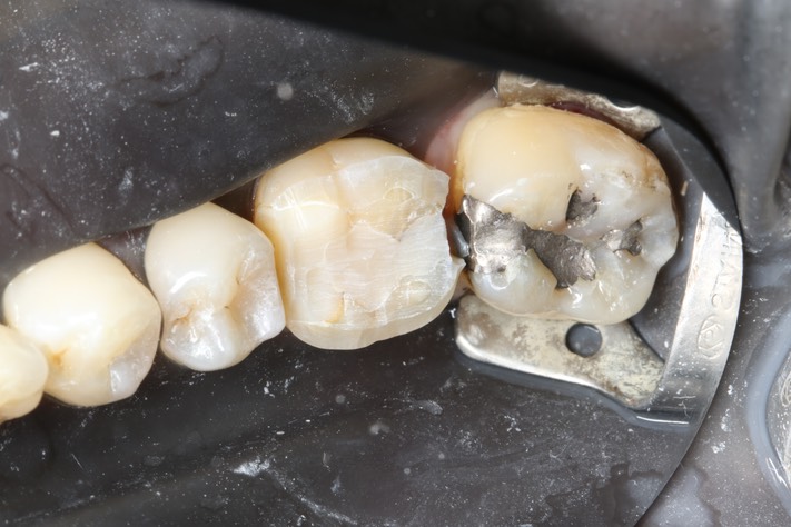 Gary Umeda #18,19,20 pre-op