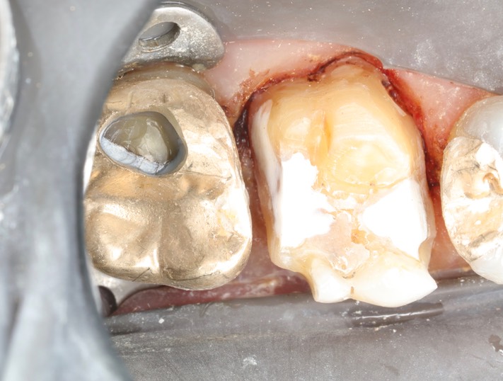 Gary Umeda #2-3 prep 