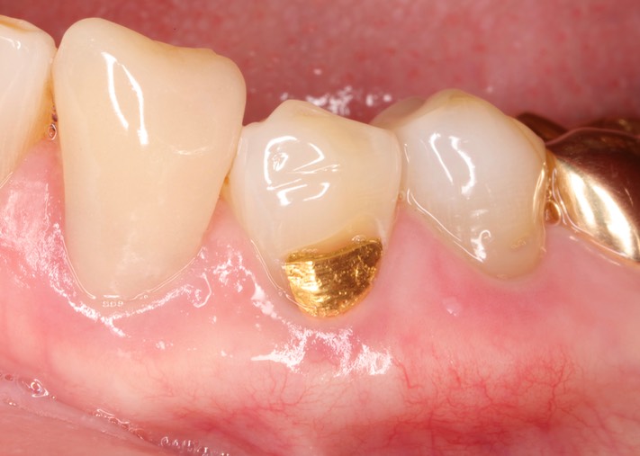 Gary Umeda #20 pre-op