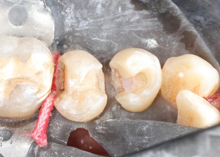 Gary Umeda #28-29 prep