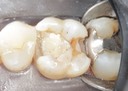 Gary Umeda #3 caries removal