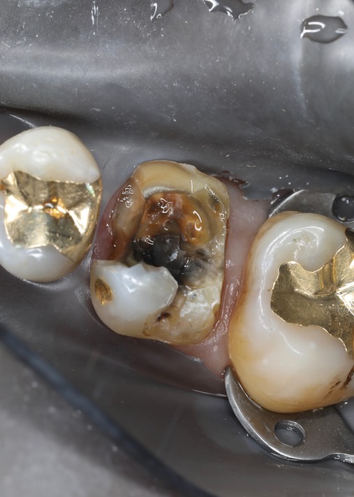 Gary Umeda #3 crown removal