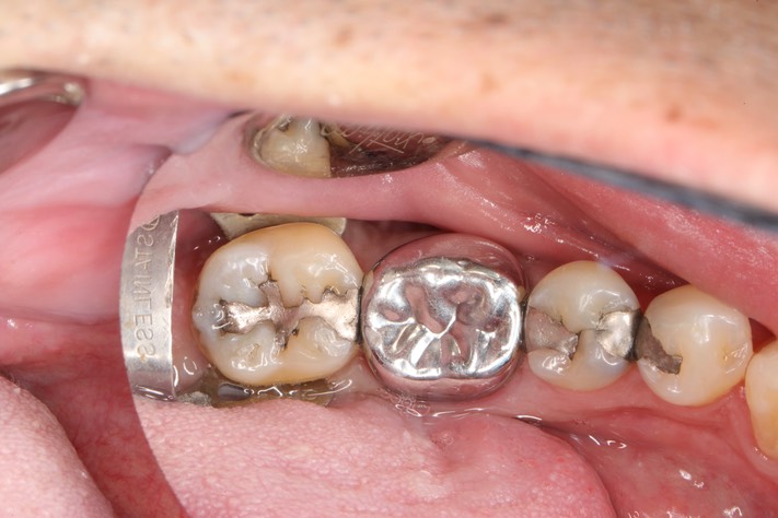 Gary Umeda #30 - 31 pre-op