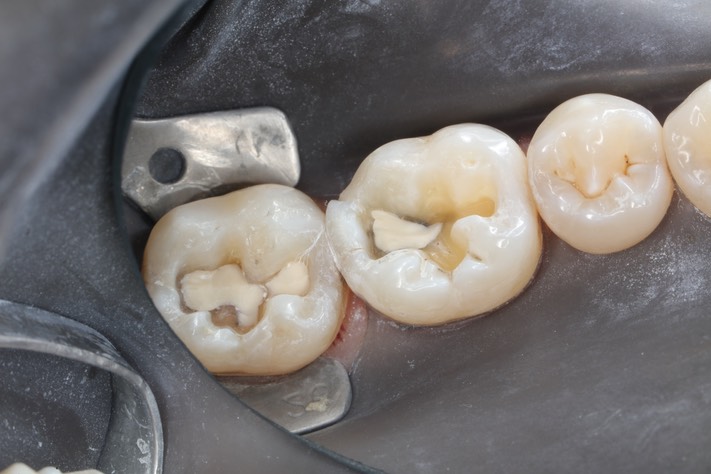 Gary Umeda #30-31 prep