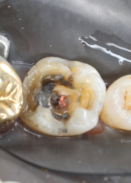 Gary Umeda #30 crown removal