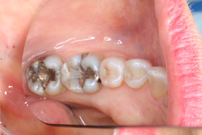 Gary Umeda #30 pre-op