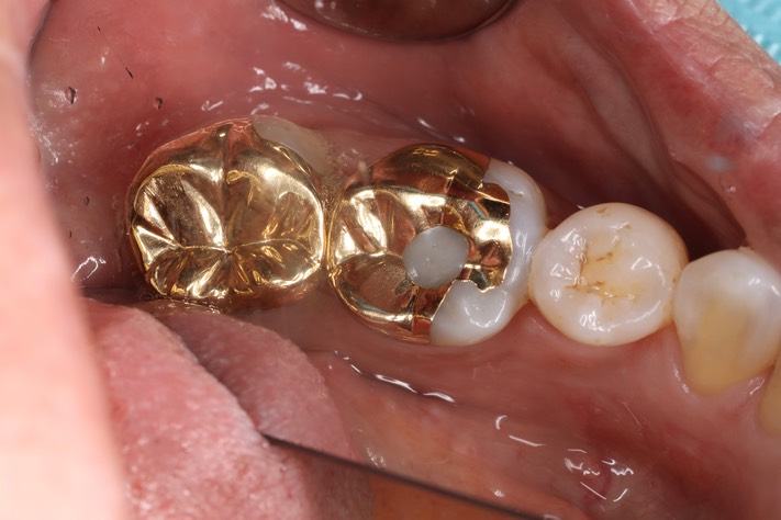 Gary Umeda #30 pre-op