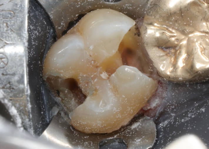 Gary Umeda #31 caries removal