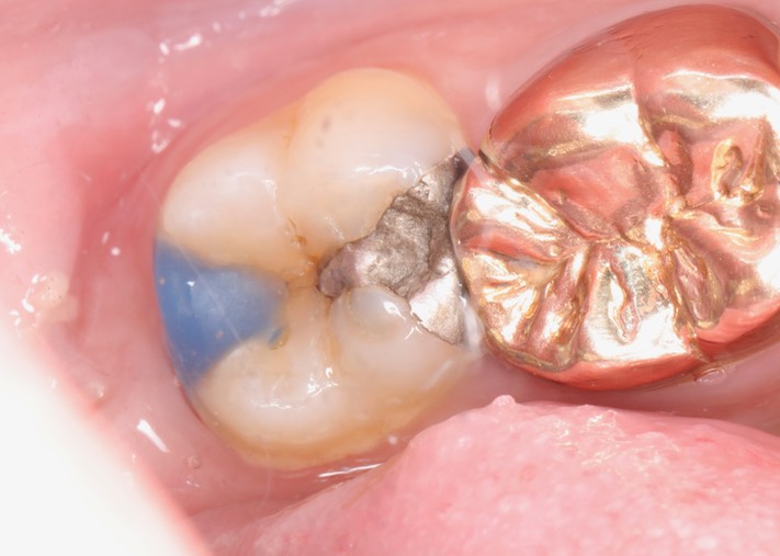 Gary Umeda #31 pre-op