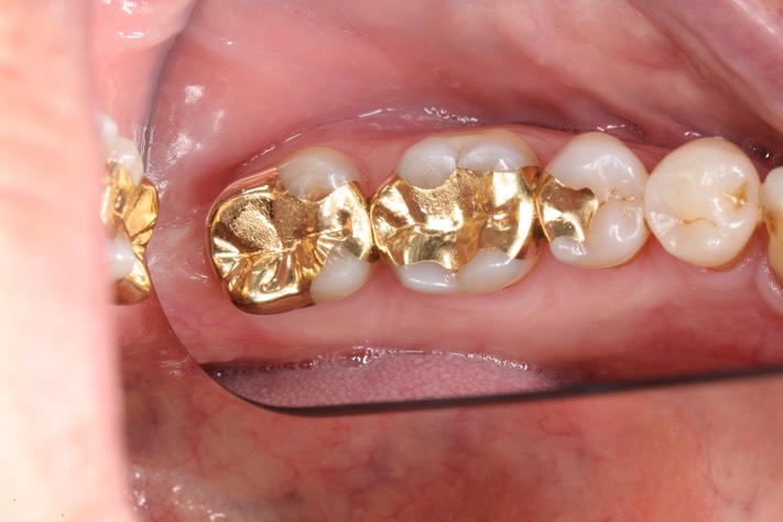 Gary Umeda #31 pre-op