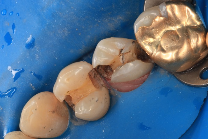 Gary Umeda #4,5,6 amalgam removal