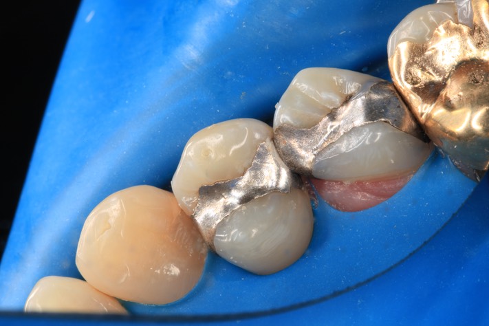 Gary Umeda #4,5,6 rubber dam