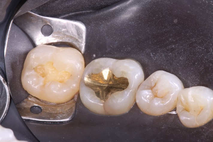 Mason Savage #31 caries removal