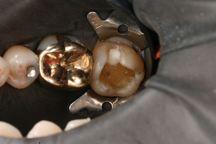 Alan Chinn #18 re-prep