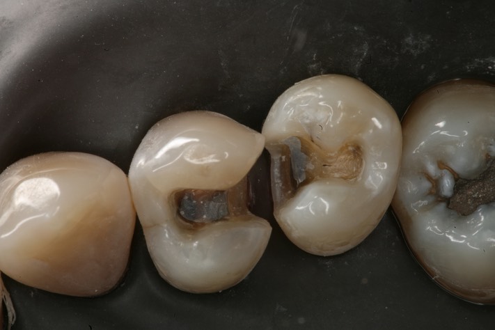 Kyle Chock #4-5 prep