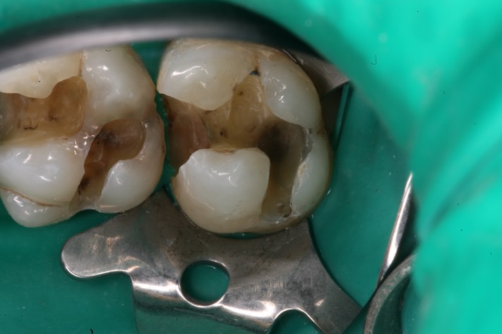 Ted Kanamori #2-3 caries removal