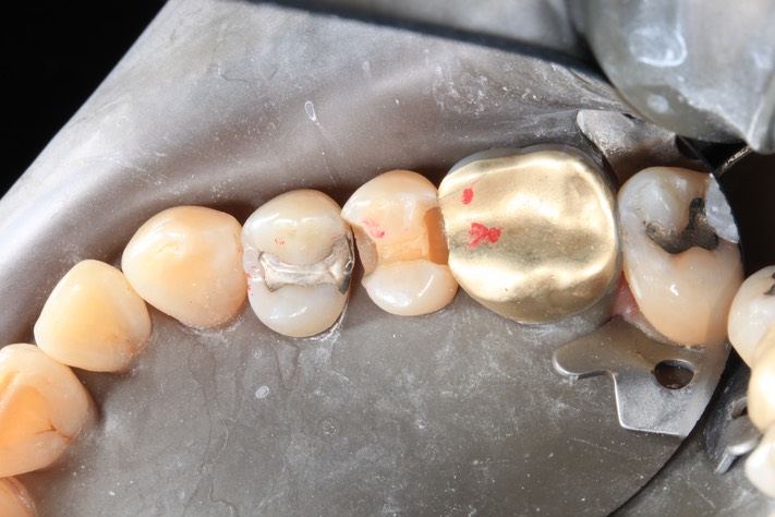 Russ Tabata #4 composite removal