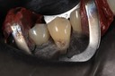 Gary Umeda #28 amalgam removal